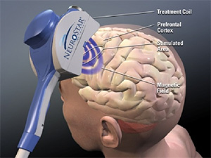 TMS Therapy